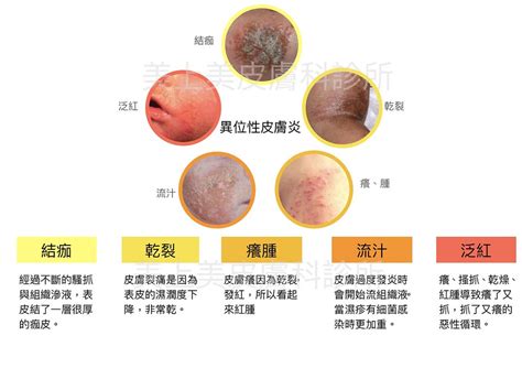 遺傳皮膚病|異位性皮膚炎